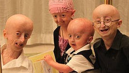 Шведские генетики научились блокировать синдром ускоренного старения организма Шведские генетики научились блокировать синдром ускоренного старения организма